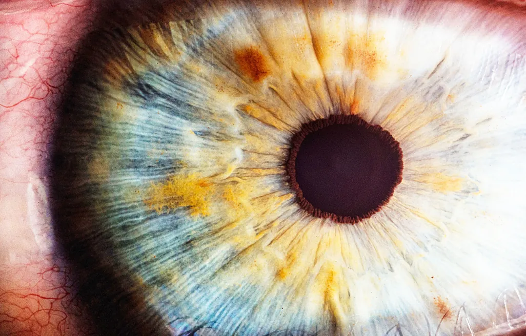 Close-up of a human eye, illustrating the GenSight Biologics sight restoration project Close-up of a human eye, illustrating the GenSight Biologics sight restoration project